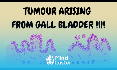 TUMOURS ARISING FROM GALL BLADDER II SYSTEMIC PATHOLOGY II ROBBINS