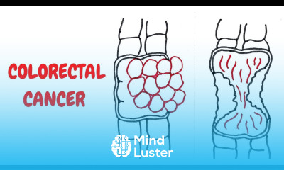 COLORECTAL CANCER II GIT II ROBBINS 10TH E II PATHOLOGY LECTURES II DrJIBRANAHMED