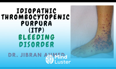 IDIOPATHIC THROMBOCYTOPENIC PURPURA II BLEEDING DISORDER II ROBBINS 10TH E II DrJIBRANAHMED