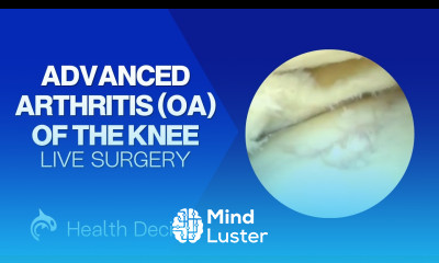 Advanced Arthritis OA of the Knee Arthroscopic Surgery