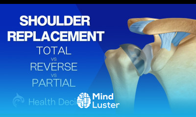 Total Reverse and Partial Shoulder Replacements 3D Animation