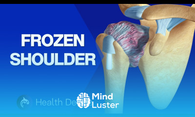 Frozen Shoulder Adhesive Capsulitis