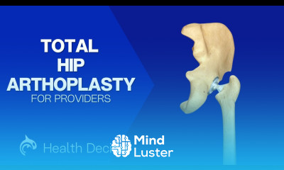 Total Hip Replacement Arthroplasty 3D Animation No Narration