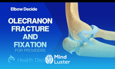 Elbow Olecranon Fracture and Fixation 3D Animation No Narration