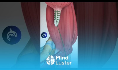 What happens if your Distal Biceps ruptures biceps 3d health