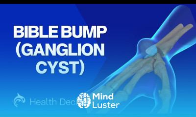 Bible Bump Ganglion Cyst 3D Animation