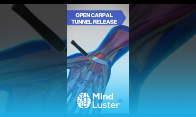 The Most Common Hand Injury Carpal Tunnel Release carpaltunnelsyndrome wristpain wristanatomy