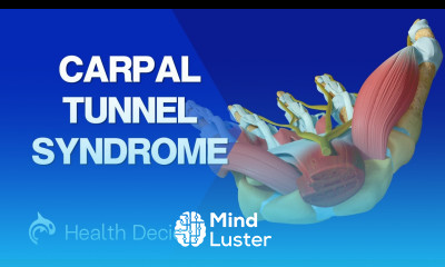 Carpal Tunnel Syndrome and Treatment 3D Animation