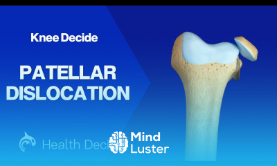 Patellar Dislocation 3D Animation Live Surgery