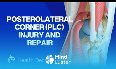 Posterolateral Corner PLC Injury and Repair 3D Animation