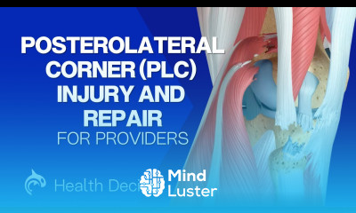 Posterolateral Corner PLC Injury and Repair 3D Animation No Narration