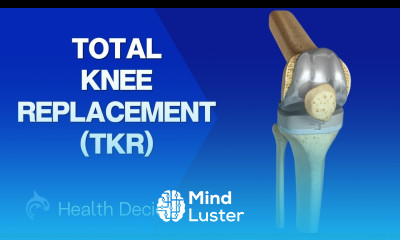 Total Knee Replacement TKR Condition Treatment and Surgery 3D Animation