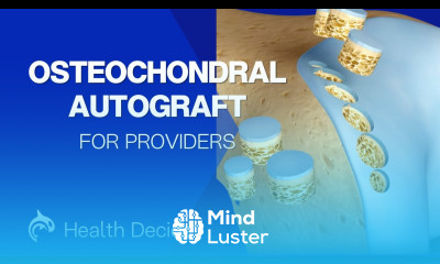 Osteochondral Autograft 3D animation No Narration