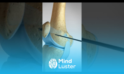 What happens when you dislocate your Knee Cap MPFL Tears and Reconstruction kneeanatomy