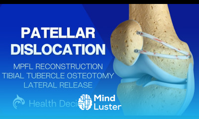 How It s Fixed Patellar Dislocation MPFL Repair Tibial Tubercle Osteotomy and Lateral Release