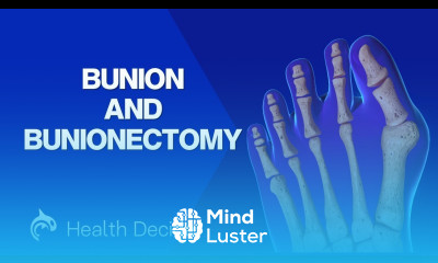 Bunion and Bunionectomy with Osteotomy 3D Animation