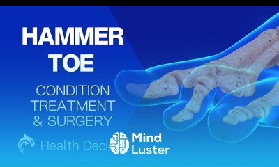 Hammer Toe Condition Treatment and Surgery 3D Animation