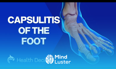 Capsulitis Pain in the Ball of the Foot