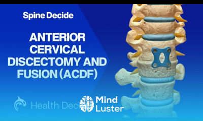 Anterior Cervical Discectomy and Fusion ACDF 3D Animation