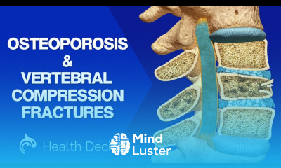 Vertebral Compression Fractures See how Osteoporosis Affects the Spine