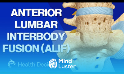 Anterior Lumbar Interbody Fusion ALIF 3D Animation