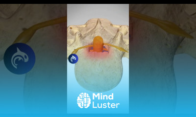 See how Lumbar Stenosis affects the Spine 3D Animation lumbarspinalstenosis backpain backpain