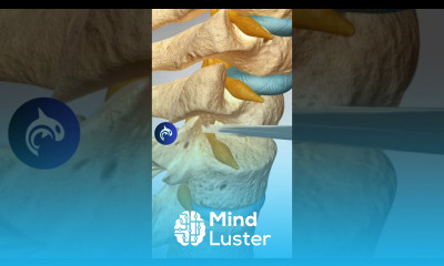 Disc Removal and Spinal Fusion Surgery ACDF 3D Animation