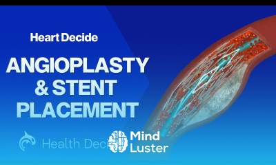 Angioplasty and Stent Placement 3D Animation