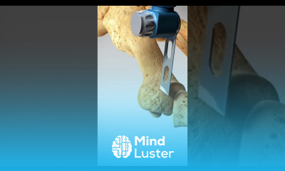 See how a bunion is treated Bunionectomy with Osteotomy toes foot feet