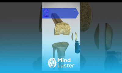 Total Knee Replacement TKR kneejoint kneeanatomy knee