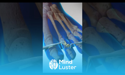 Fixing Hammer Toe Surgery That ll Blow Your Mind See How This Toe Deformity Is Corrected