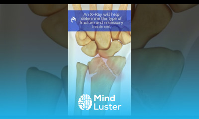 Understand Wrist Fractures 3D Animation wristfracture wristpain wristinjury