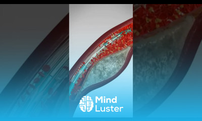 Angioplasty Stent Placement stents medicaldevices coronaryarteries