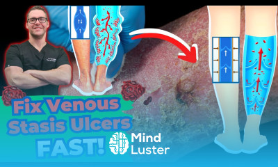 Venous Stasis Dermatitis Venous Ulcers Treatment Varicose Veins