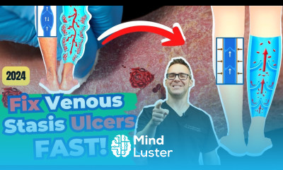 STOP Varicose Veins Venous Stasis Ulcers FAST
