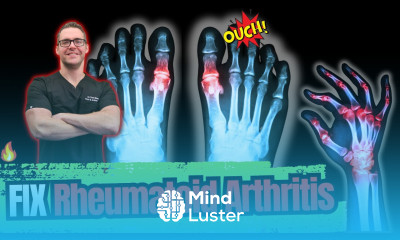 Rheumatoid Arthritis Symptoms Early Signs Stages BEST Treatment