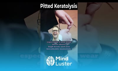 How To Get Rid of Pitted Keratolysis ONCE FOR ALL