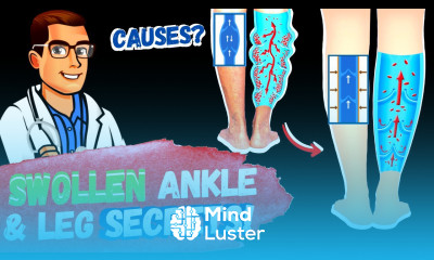 Lymphedema Treatment How to Get Rid of Swollen Feet Ankles Legs