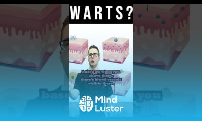 Plantar Wart Removal How to Identify a wart Treat It