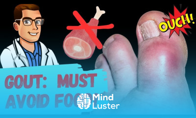 Best Gout Diet Foods To Avoid URIC ACID Foods that Cause Gout