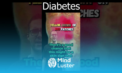 Necrobiosis Lipoidica Diabeticorum Diabetes Symptoms Sign