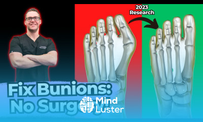 TOP 13 Ways to Shrink Bunions Naturally 1 HUGE SECRET