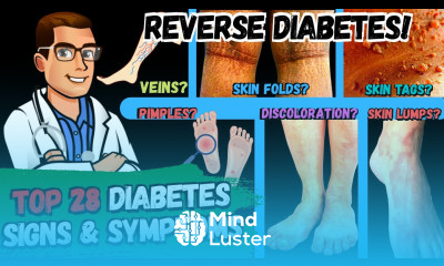28 Diabetes Signs Symptoms REVERSE DIABETES 2 BIG SECRETS