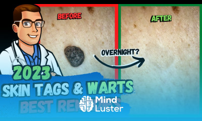 Skin Tags Plantar Warts DISAPPEAR Overnight Best Home Remedies