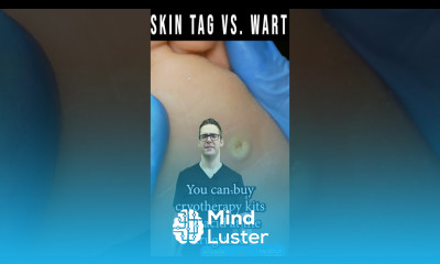 Skin Tag Removal Wart Removal How To Get Rid Of Skin Tags Warts