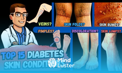 TOP 15 Diabetes Skin Signs Symptoms Type 2 1 Diabetes Mellitus