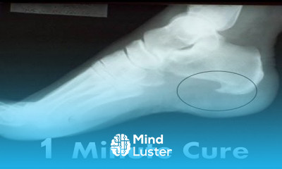 Plantar Fascia Heel Spur Pain BEST Home Treatment Remedies