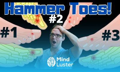 Claw Toe Hammer Toe Treatment Straighten Your Toes NO SURGERY