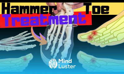 Hammer Toe Exercises Stretches Treatment Claw Toes Mallet Toes
