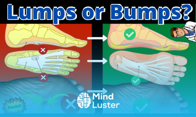 Bump on the Bottom of My Foot Plantar Fibroma Treatment Massage